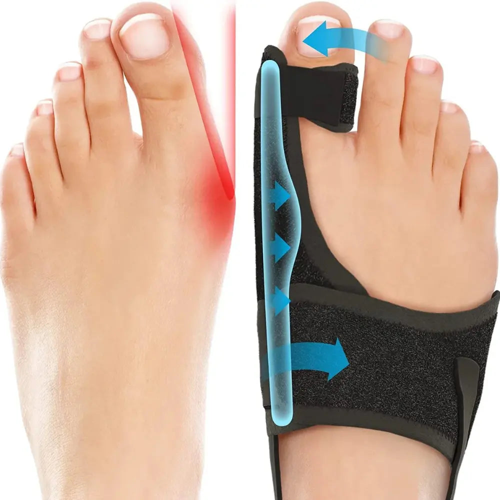 Hallux Valgus Nachtschiene – Vorher Nachher Zehenkorrektur mit Aluminiumschiene
